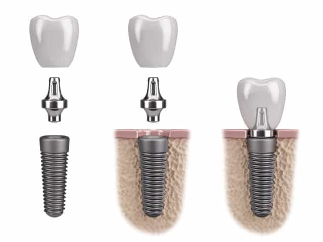 Wondering If Dental Implants Will Work For You? Find Out Here!
